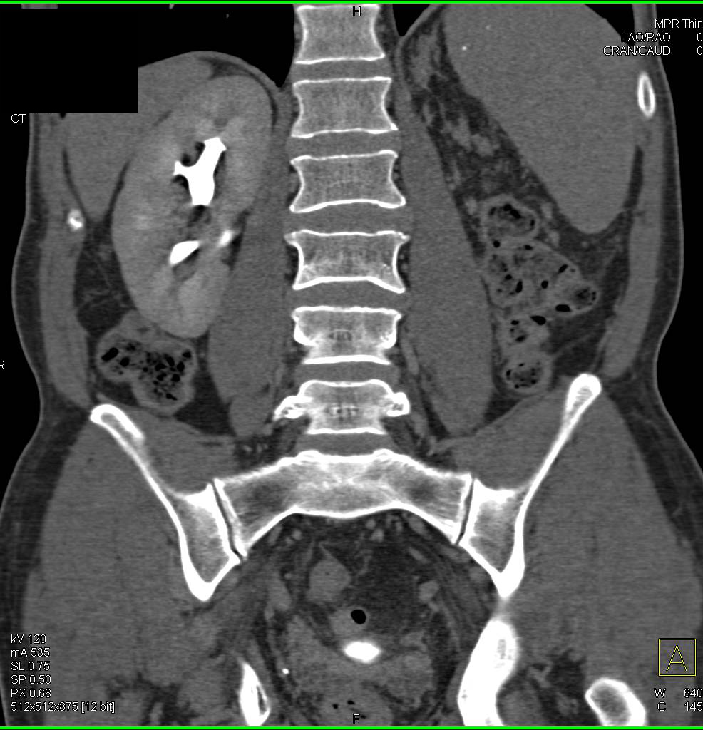 Recurrent Renal Cell Carcinoma Metastatic to the Pancreas - CTisus CT Scan