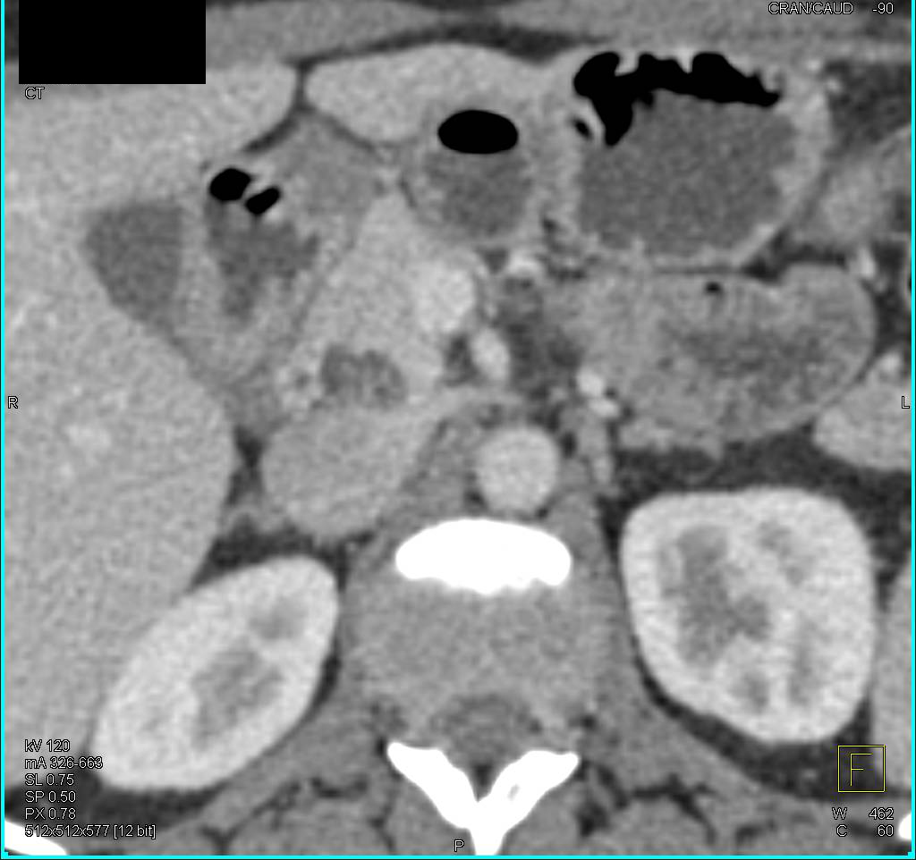 Intraductal Papillary Mucinous Neoplasm (IPMN) with Mural Nodule - CTisus CT Scan