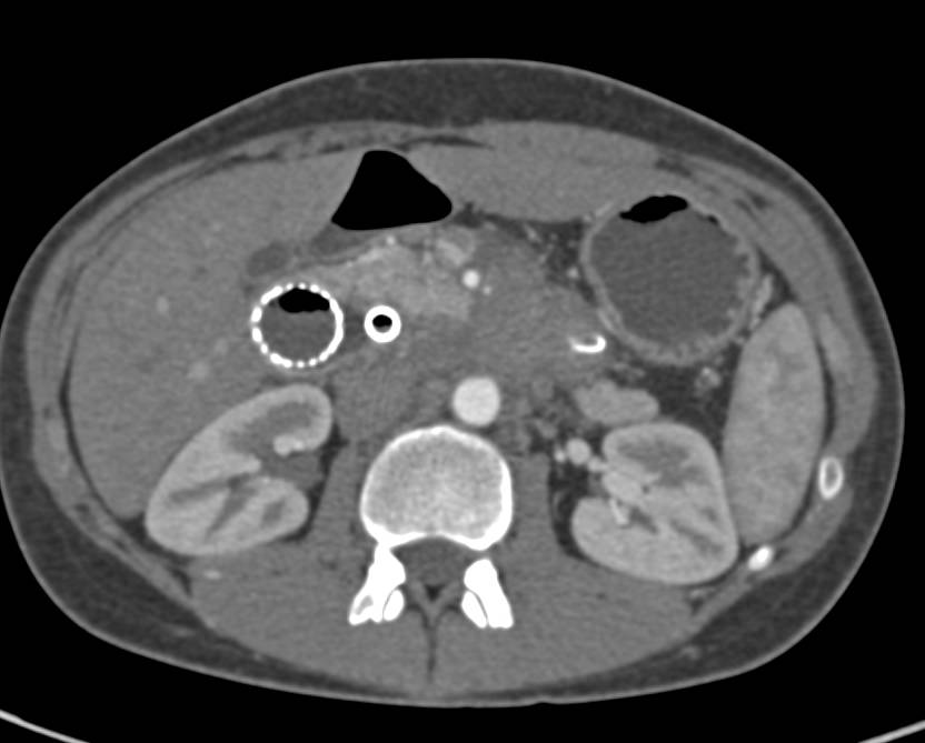 Pancreatic Cancer Invades the Duodenum. Stents Placed in the Duodenum - CTisus CT Scan