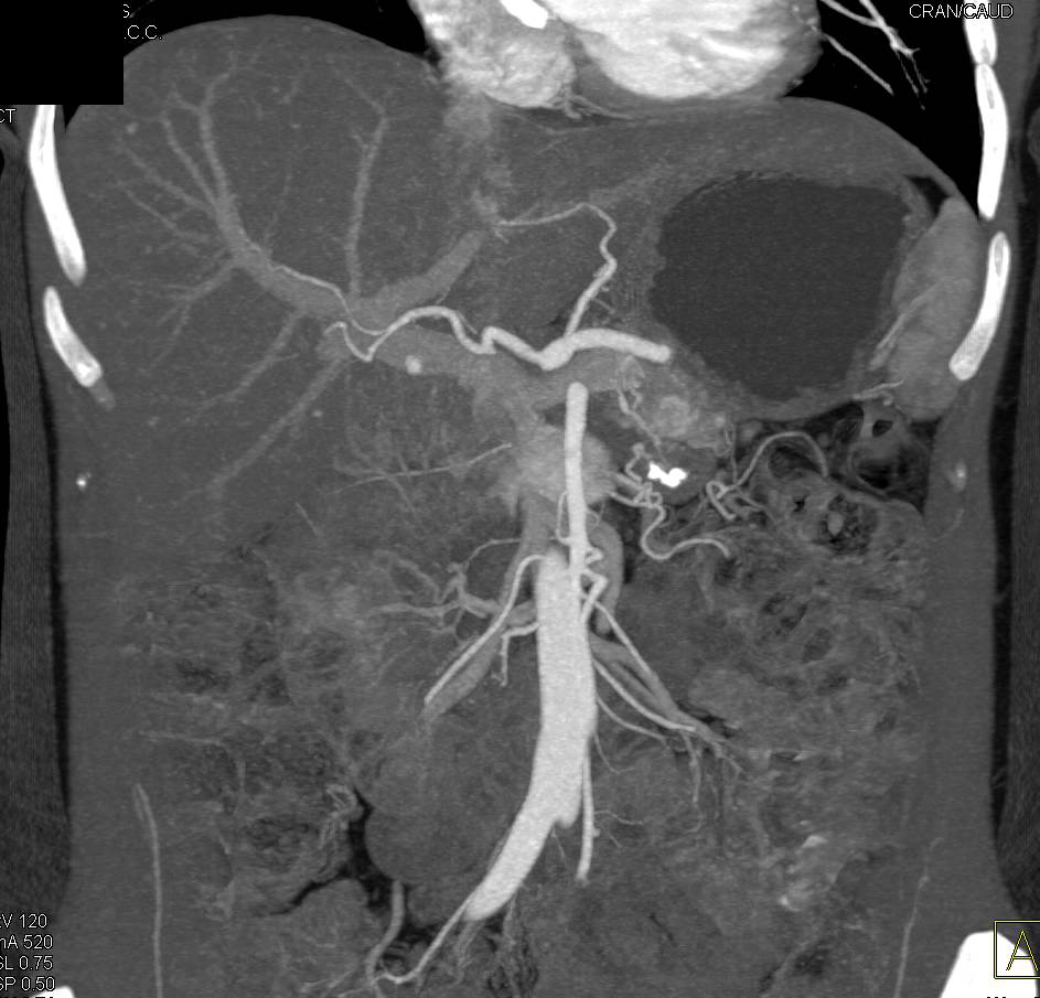 Von Hippel-Lindau syndrome (VHL) Patient with Multiple Islet cell Tumors in the Pancreas with Liver Metastases. Prior Bilateral Adrenalectomies - CTisus CT Scan