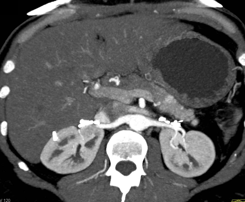 Neuroendocrine Tumors in the Pancreas - CTisus CT Scan