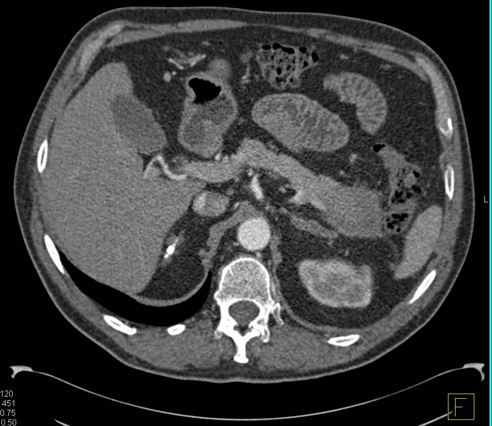 Autoimmune Pancreatitis Simulates a Carcinoma of the Tail of the Pancreas. Mesenteric Fibrosis also seen. - CTisus CT Scan