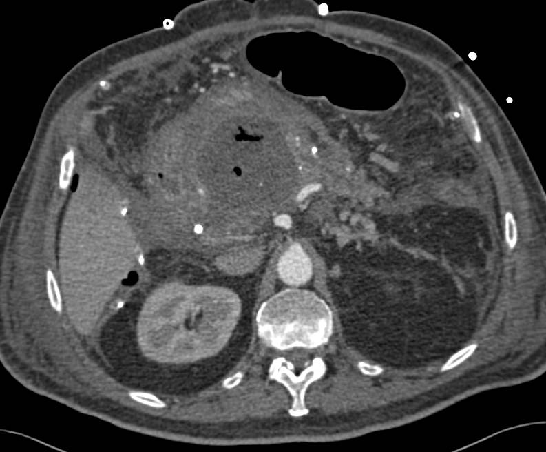Pancreatic Abscess - CTisus CT Scan