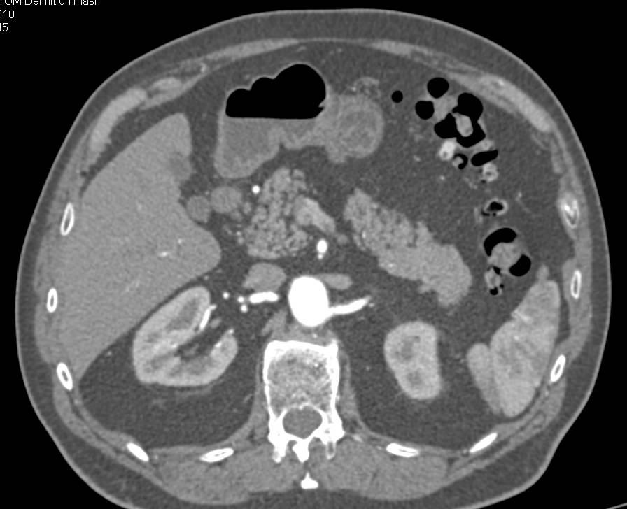 Fatty Infiltration of the Head of the Pancreas - CTisus CT Scan