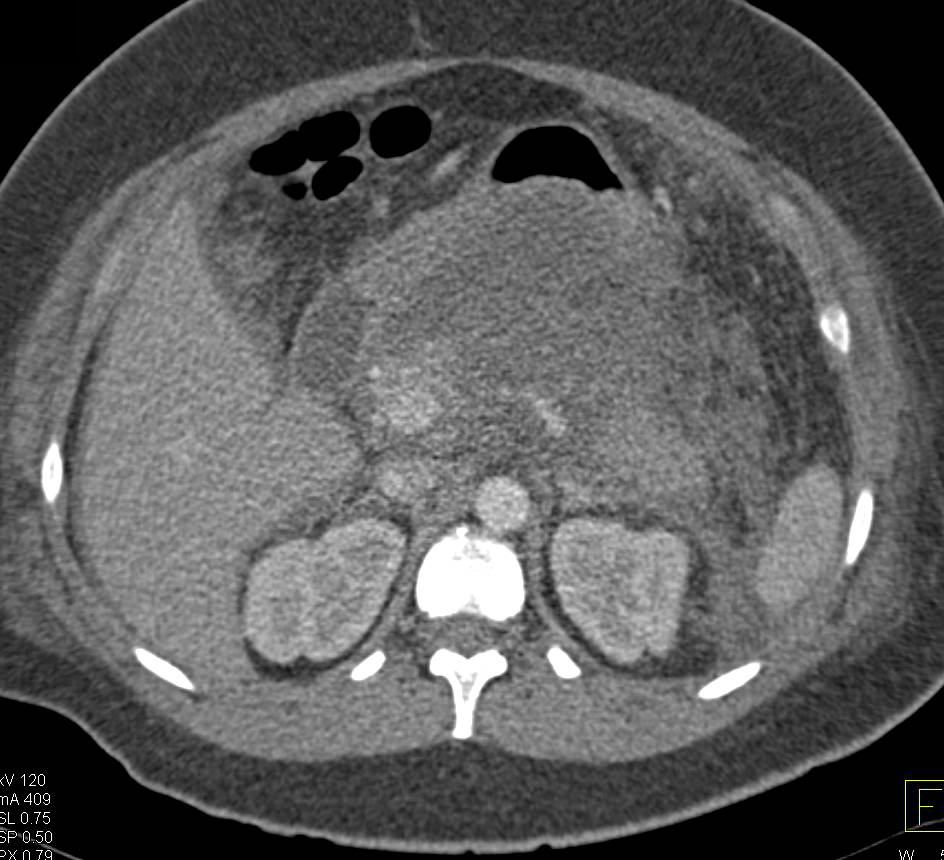Acute Pancreatitis with Pancreatic Necrosis - CTisus CT Scan