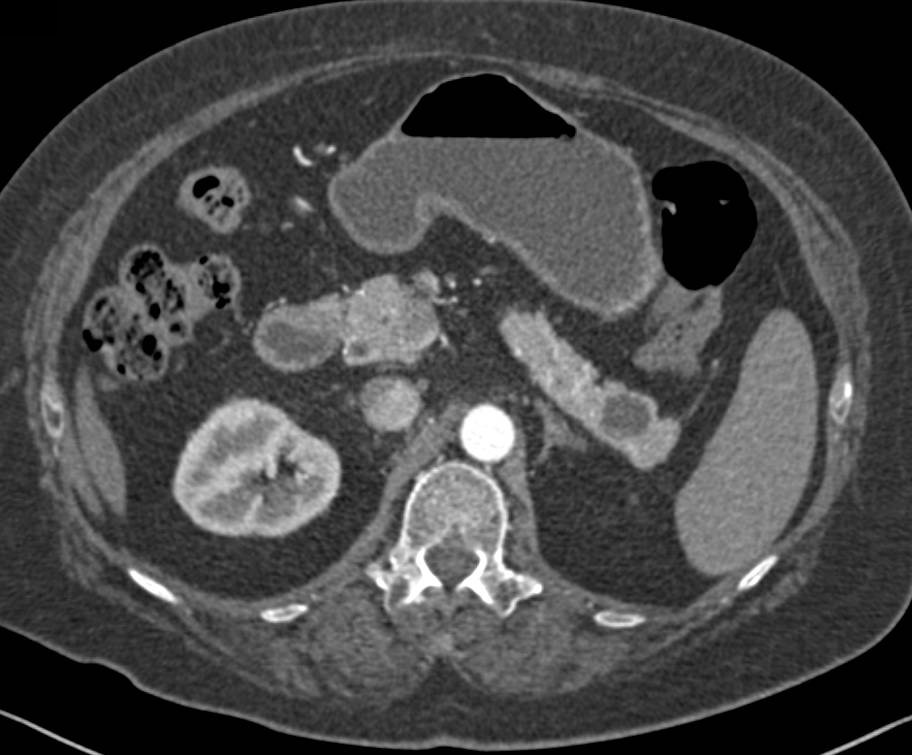 Cystic Islet Cell Tumor-Note Rim Enhancement on Arterial Phase Imaging - CTisus CT Scan