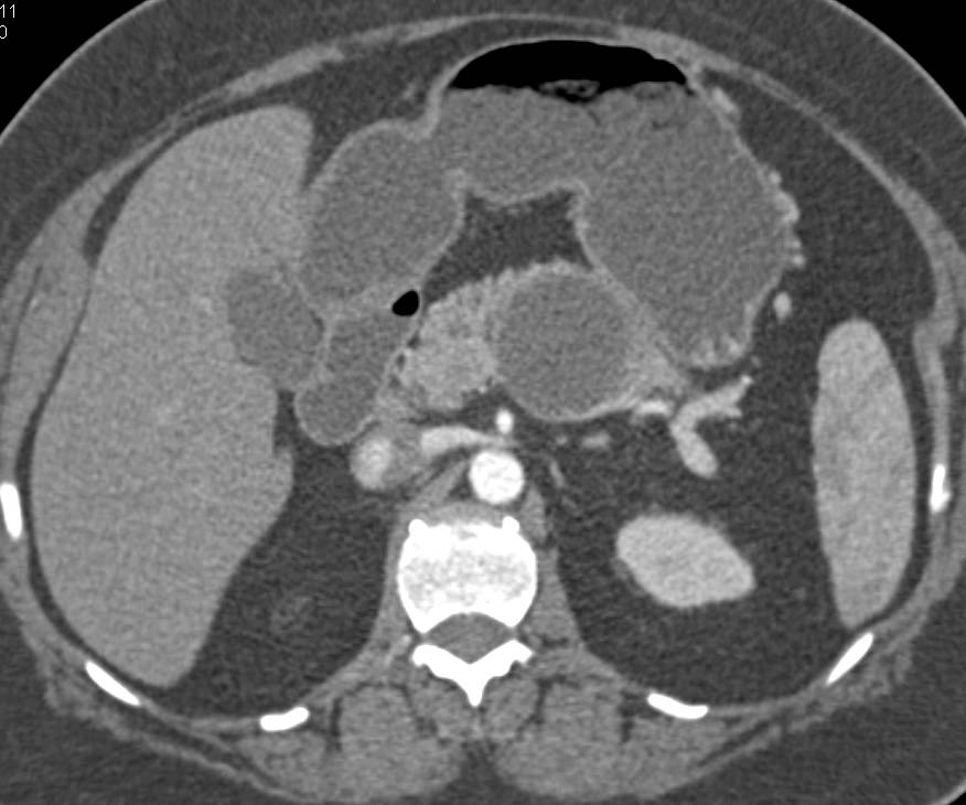 Mucinous Cystic Neoplasm of the Pancreas (MCN) - CTisus CT Scan