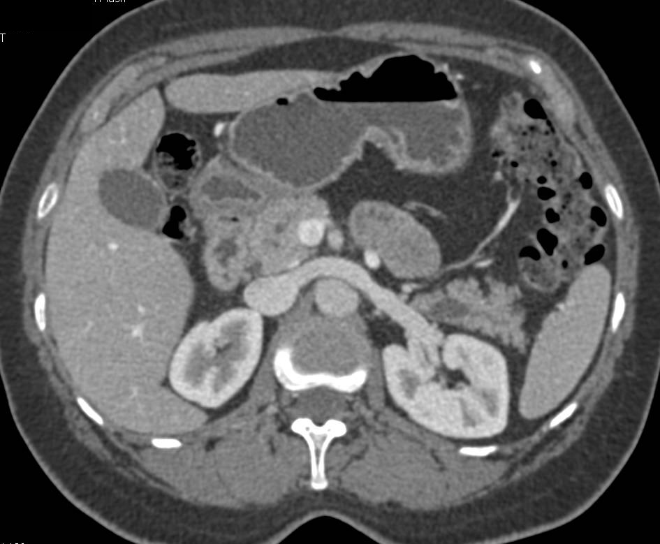 Side Branch Intraductal Papillary Mucinous Neoplasm (IPMN) in the Tail of the Pancreas - CTisus CT Scan