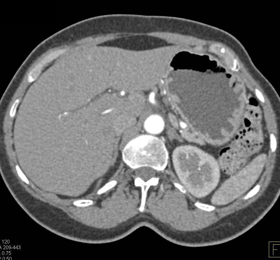 Multiple Pancreatic Intraductal Papillary Mucinous Neoplasms (IPMNs) - CTisus CT Scan