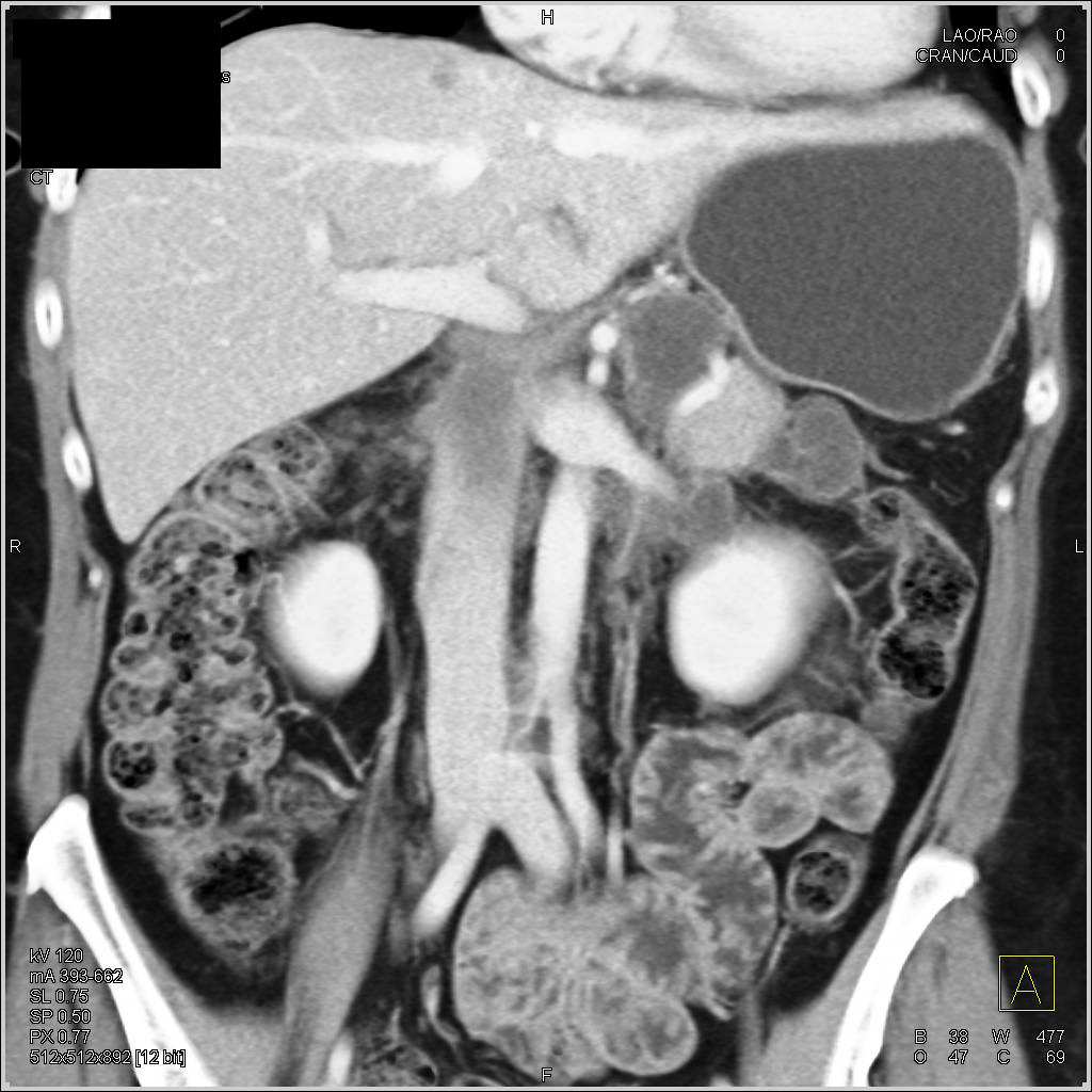 Multiple Pancreatic Pseudocysts - CTisus CT Scan
