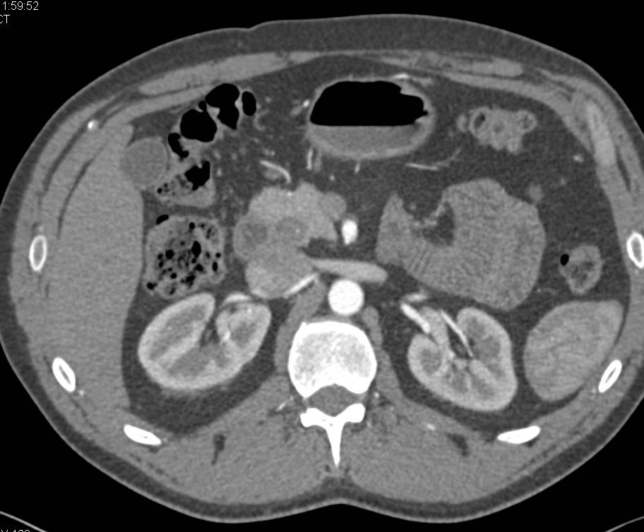 Subtle Pancreatic Cancer in the Pancreatic Head - CTisus CT Scan