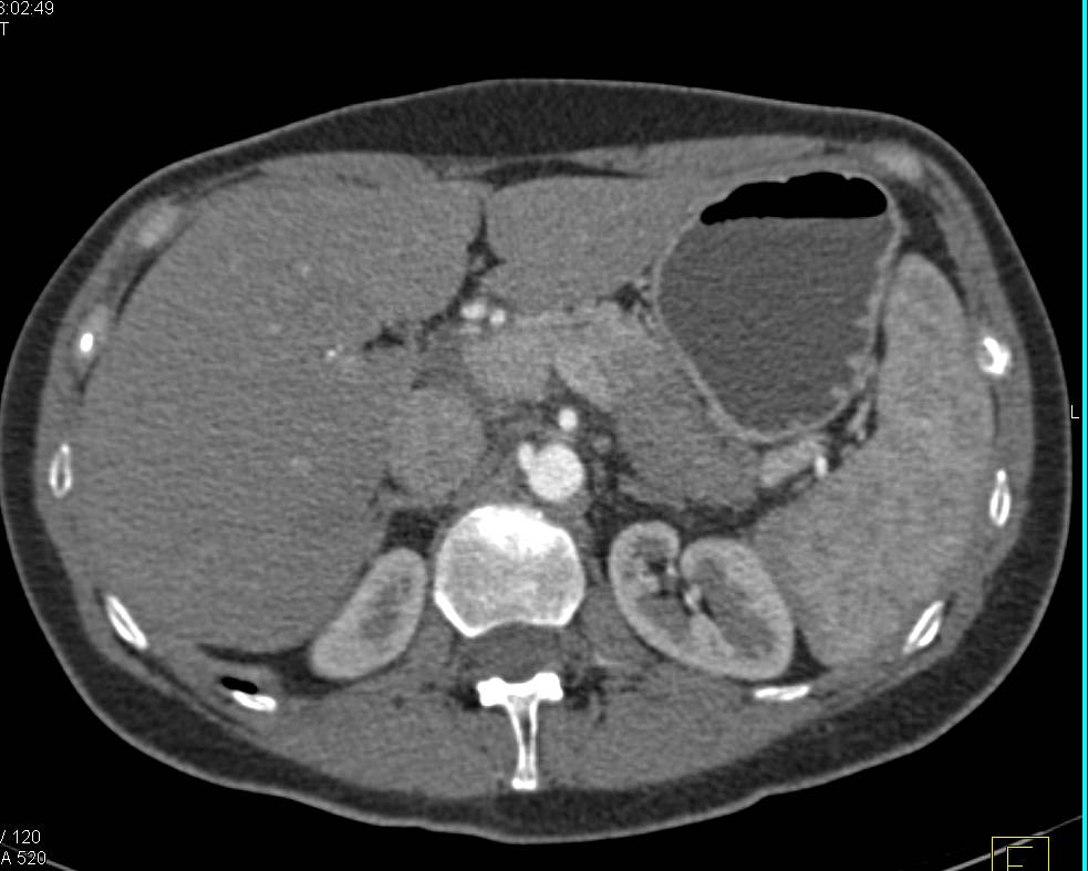 Autoimmune Pancreatitis - CTisus CT Scan