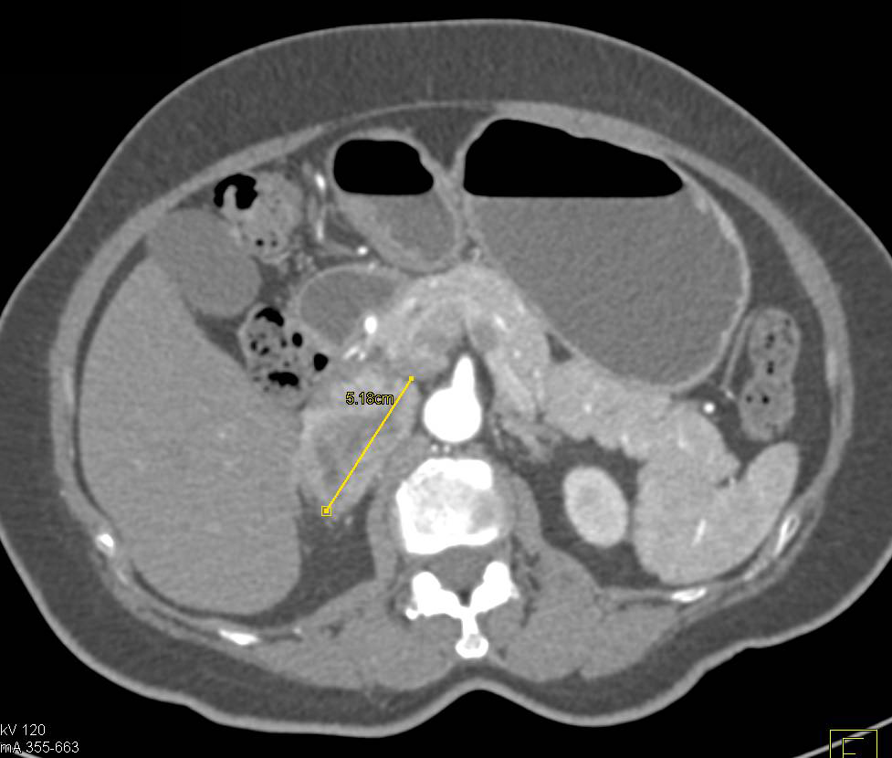 Paraganglioma Near Head of Pancreas Simulates a Pancreatic Mass - CTisus CT Scan