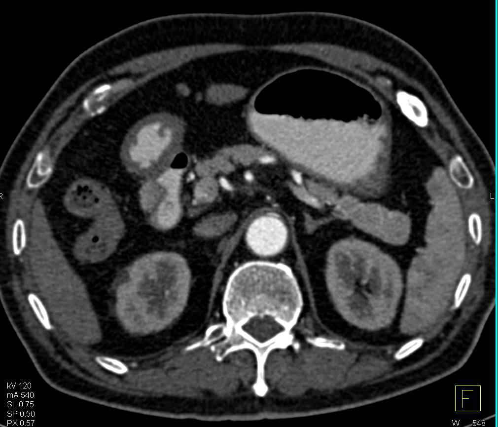 Annular Pancreas Simulates a Duodenal Mass - CTisus CT Scan