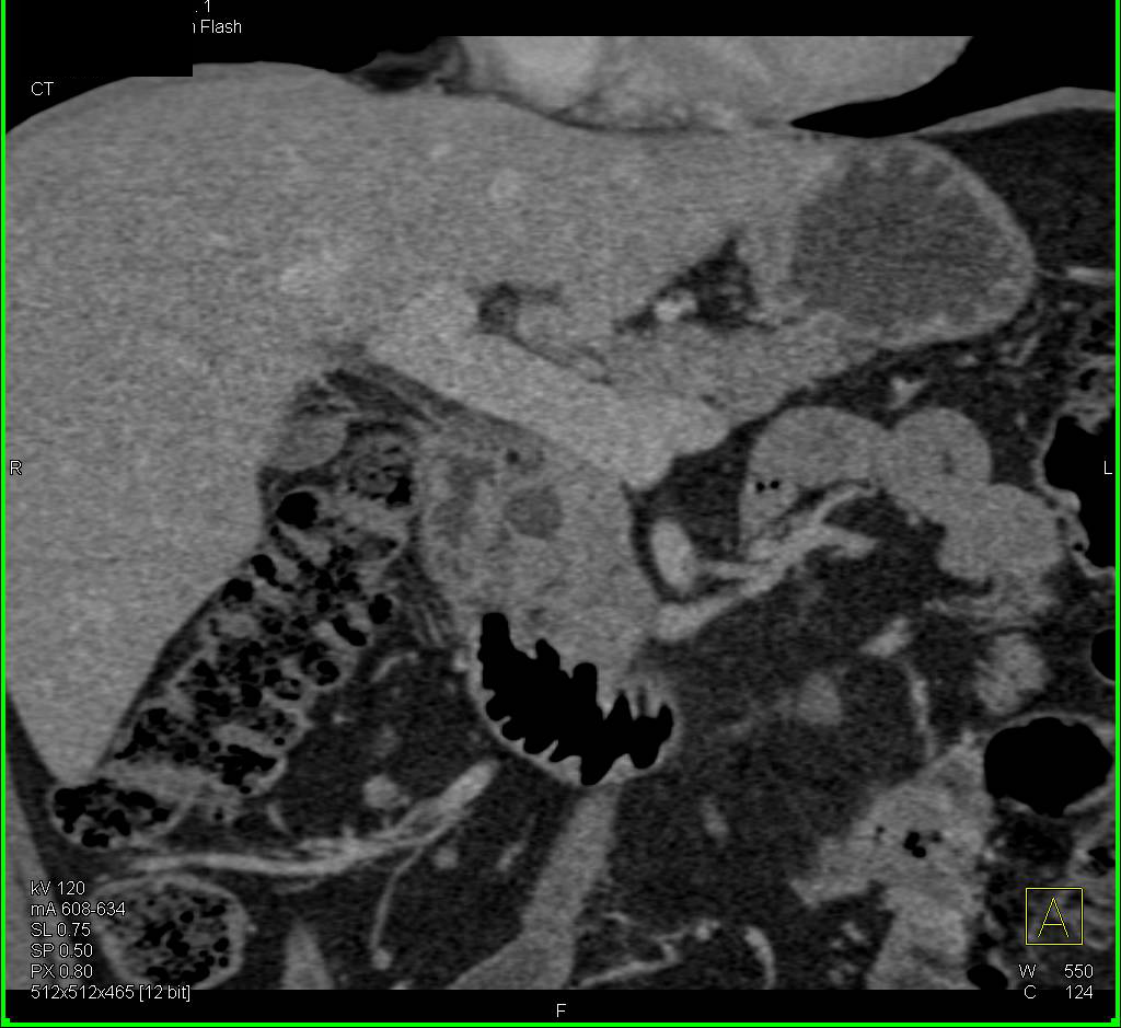 Intraductal Papillary Mucinous Neoplasm (IPMN) - CTisus CT Scan