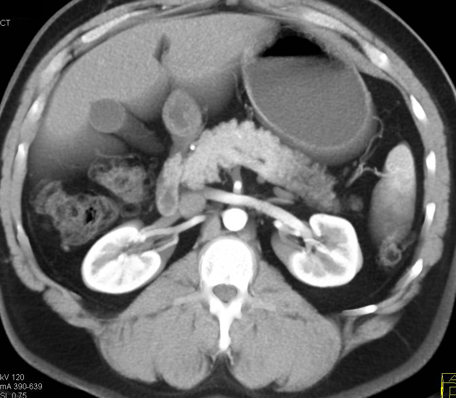Focal Fatty Infiltration in the Tail of the Pancreas - CTisus CT Scan