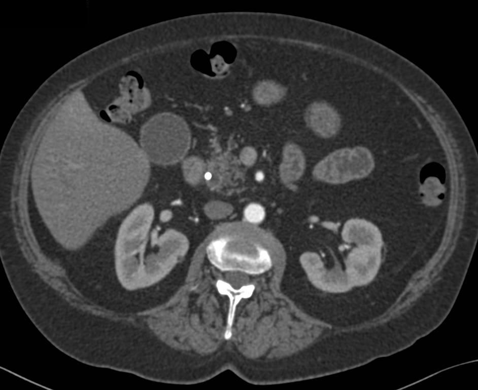 Ampullary Carcinoma - CTisus CT Scan