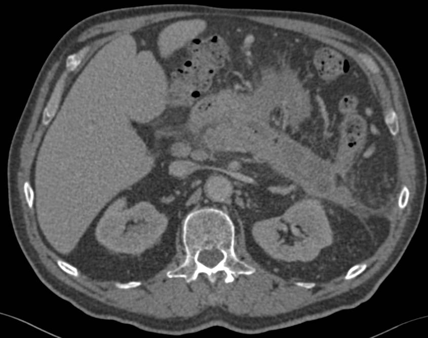 Acute Pancreatitis with Pancreatitis Necrosis - CTisus CT Scan