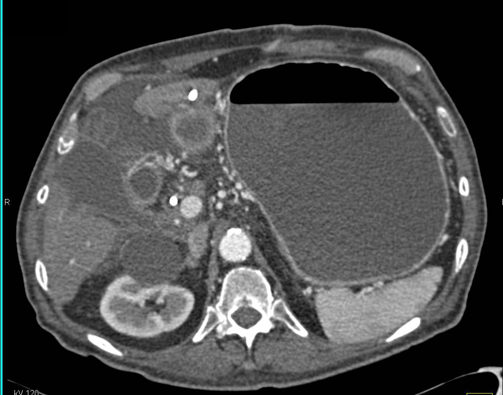 Pancreatic Cancer Obstructs the Duodenum - CTisus CT Scan
