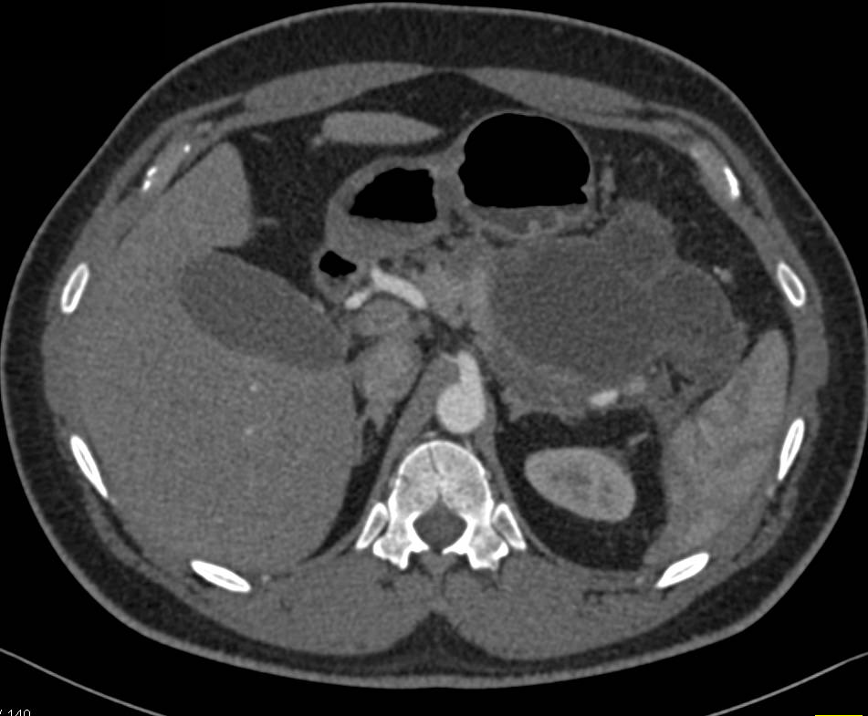 Pancreatitis with Pseudocysts Near Tail of the Pancreas and Left Anterior Pararenal Space - CTisus CT Scan