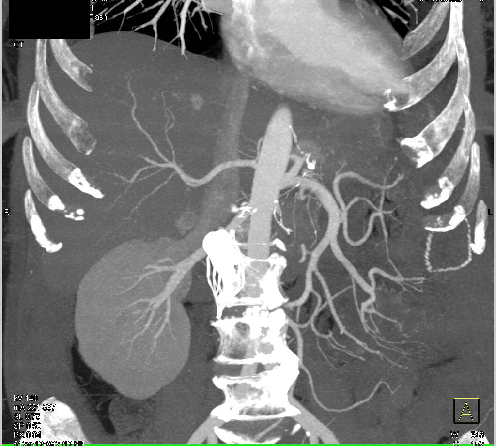 VIPOMA of the Pancreatic Tail Looking Like a Gastric GIST Tumor - CTisus CT Scan