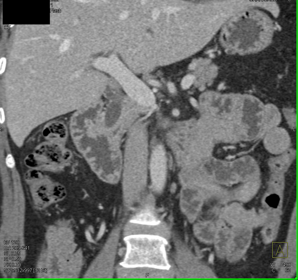 Ampullary Carcinoma - CTisus CT Scan