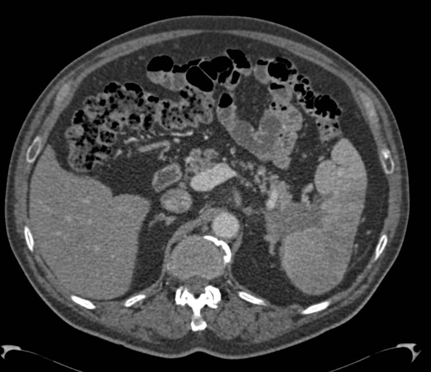 Carcinoma of the Tail of the Pancreas Invades the Spleen with Splenic Infarction Seen - CTisus CT Scan