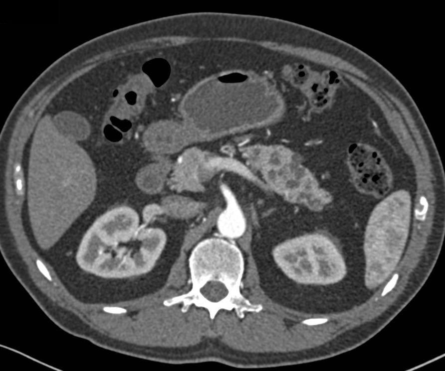 Multiple Intraductal Papillary Mucinous Neoplasms (IPMNs) - CTisus CT Scan