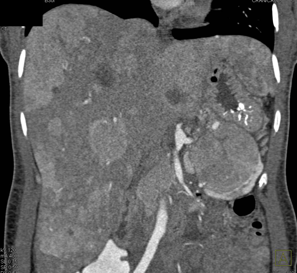 Islet Cell Tumor (Neuroendocrine Tumor) of the Pancreatic Tail with Liver Metastases - CTisus CT Scan