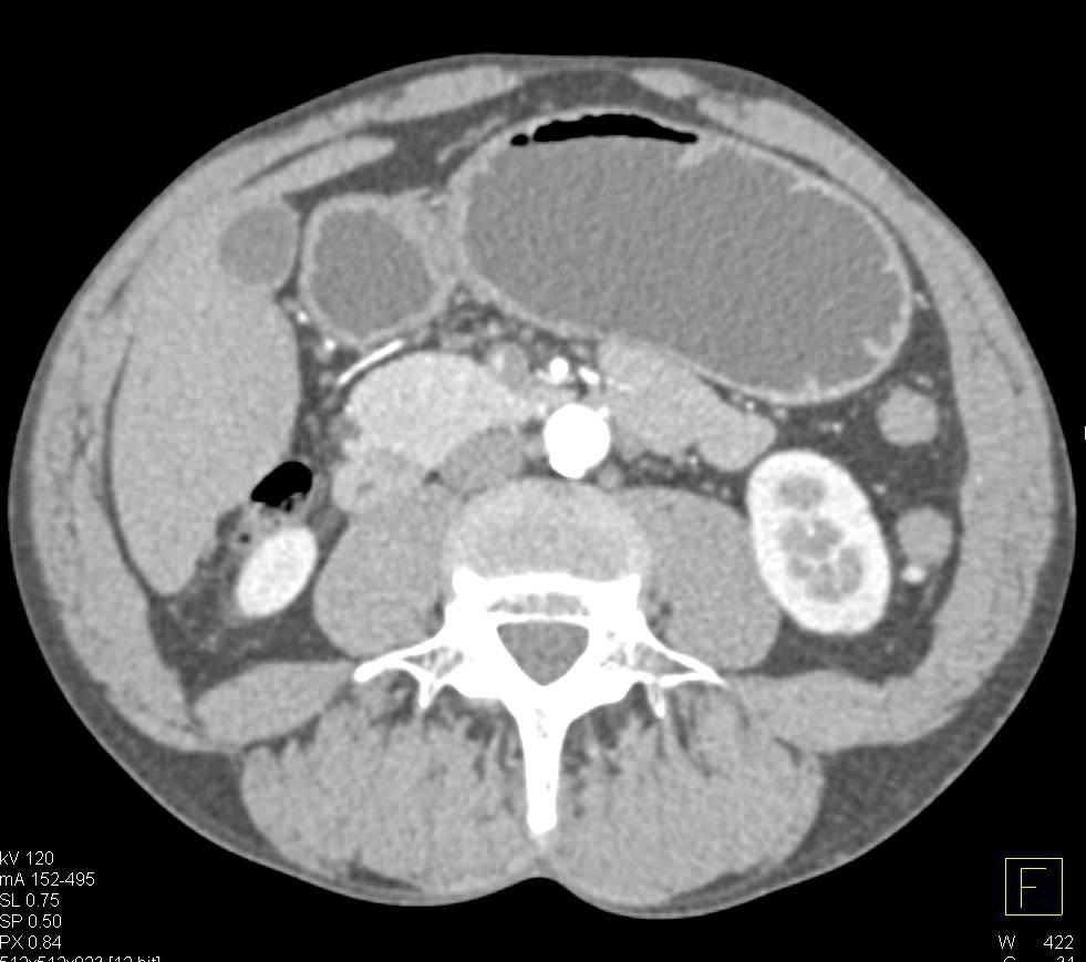 Normal Pancreas in 3D - CTisus CT Scan
