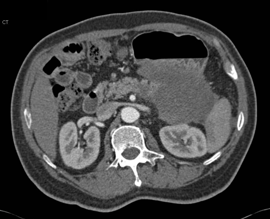 Carcinoma of the Tail of the Pancreas Looks Like a Gastric GIST Tumor - CTisus CT Scan