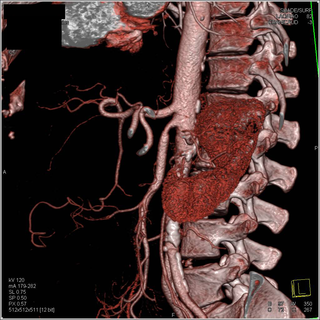Mucinous Cystadenocarcinoma with Encasement of Portal Vein and Superior Mesenteric Vein (SMV) and Narrows Superior Mesenteric Artery (SMA) - CTisus CT Scan