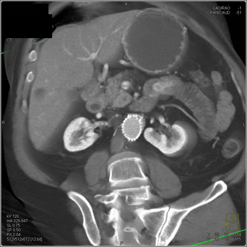 Carcinoma Tail of Pancreas with Incidental GIST of Small Bowel - CTisus CT Scan