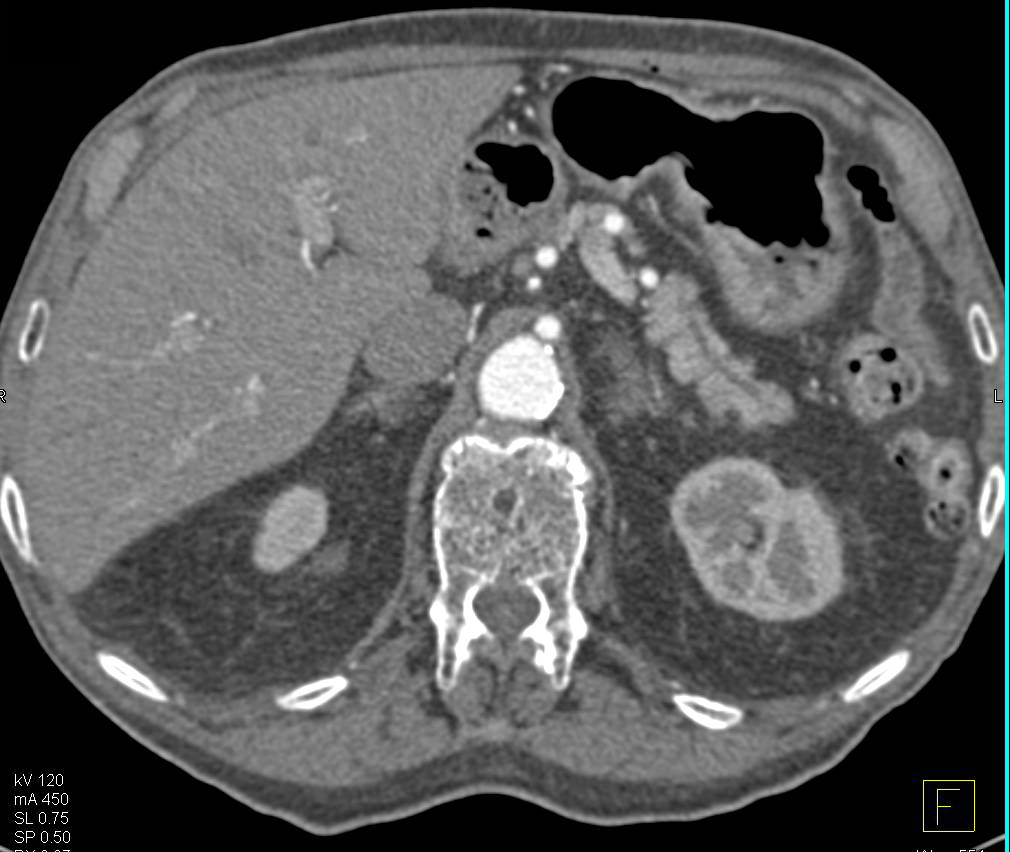 Side Branch Pancreatic Intraductal Papillary Mucinous Neoplasm (IPMN) - CTisus CT Scan