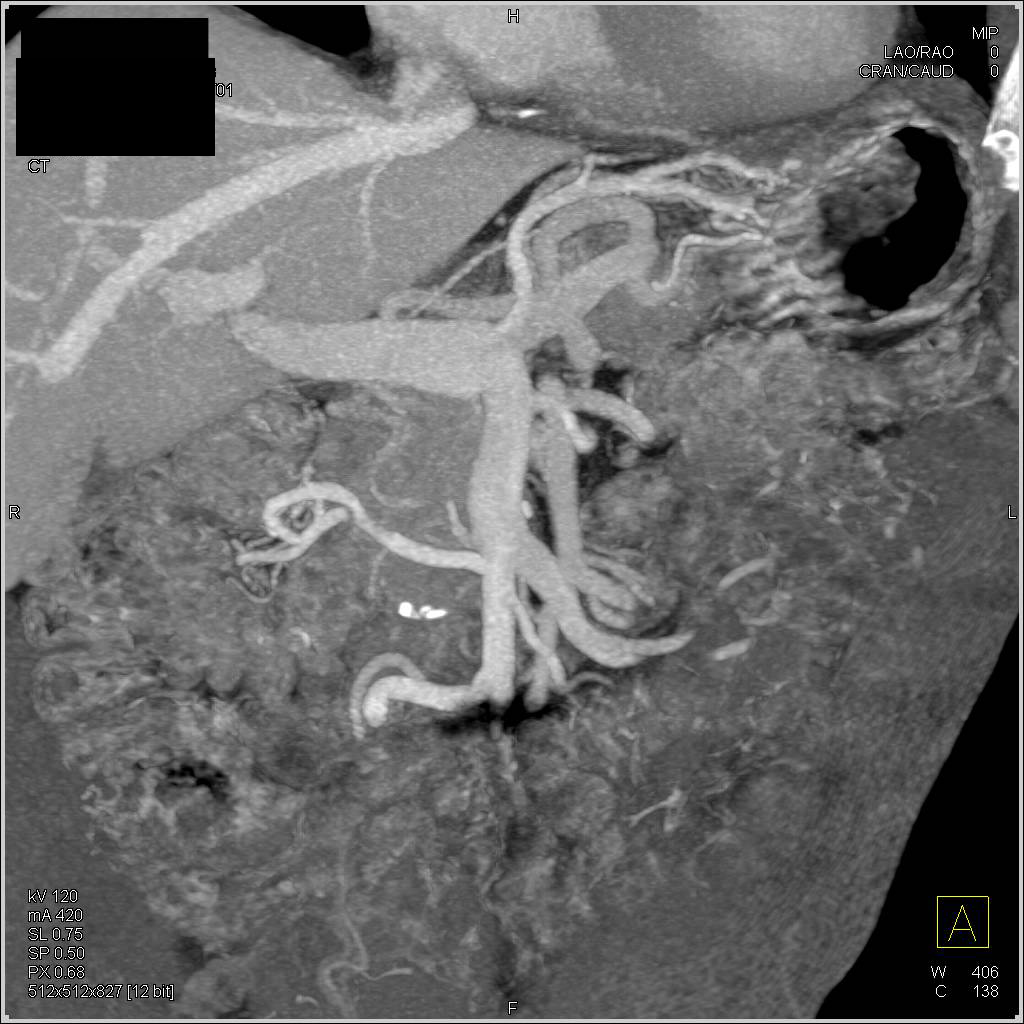 Intraductal Papillary Mucinous Neoplasm (IPMN) - CTisus CT Scan