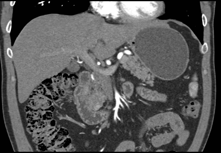 Neuroendocrine Tumor in Head of Pancreas - CTisus CT Scan