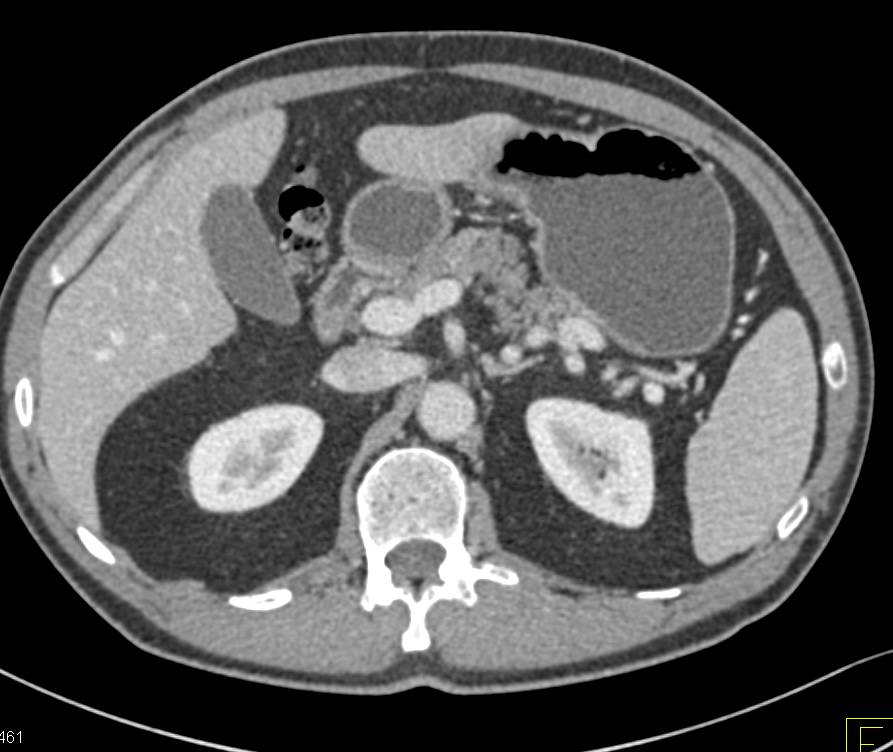 Neuroendocrine Tumor in Head of Pancreas - CTisus CT Scan