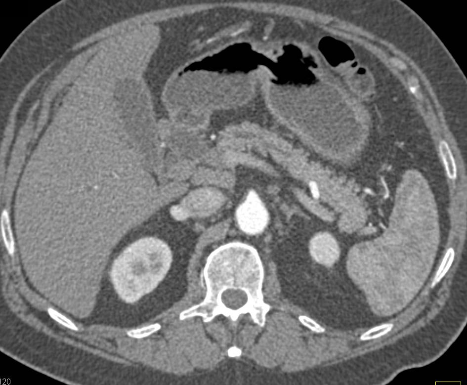 Ampullary Carcinoma and Double Duct Sign - CTisus CT Scan