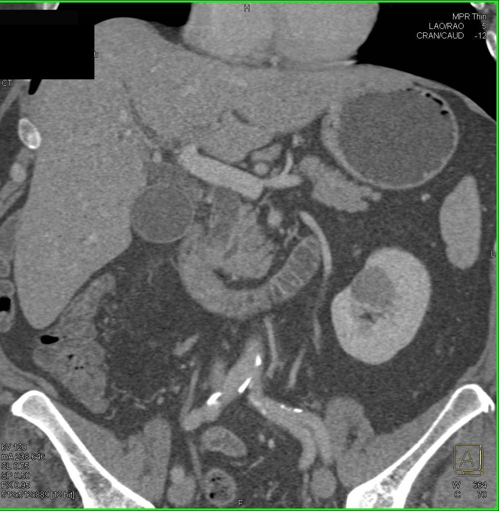 Ampullary Carcinoma Which is Hard to Distinguish from a Duodenal Carcinoma - CTisus CT Scan