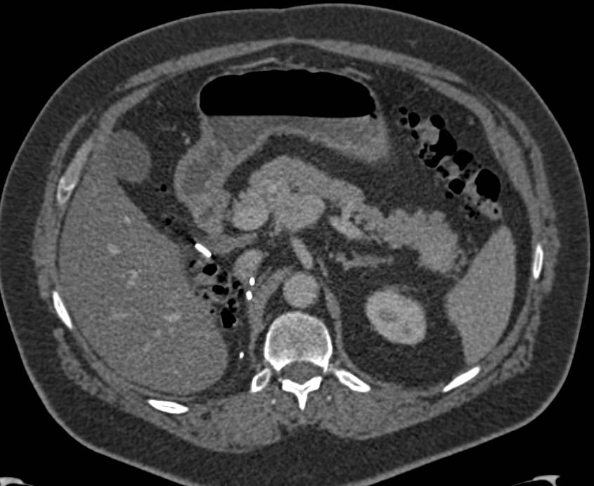 Renal Cell Carcinoma Recurrence with Multiple Enhancing Pancreatic Metastases - CTisus CT Scan