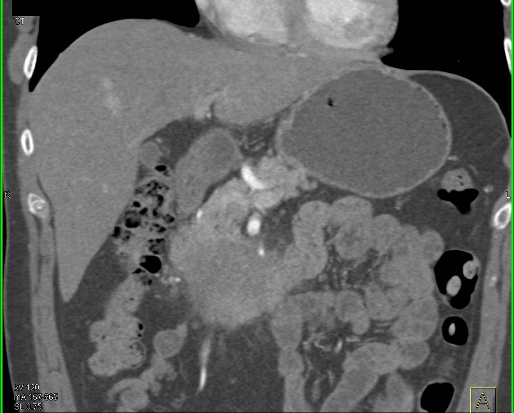Adenocarcinoma of the Pancreas with Superior Mesenteric Artery (SMA) Encasement - CTisus CT Scan
