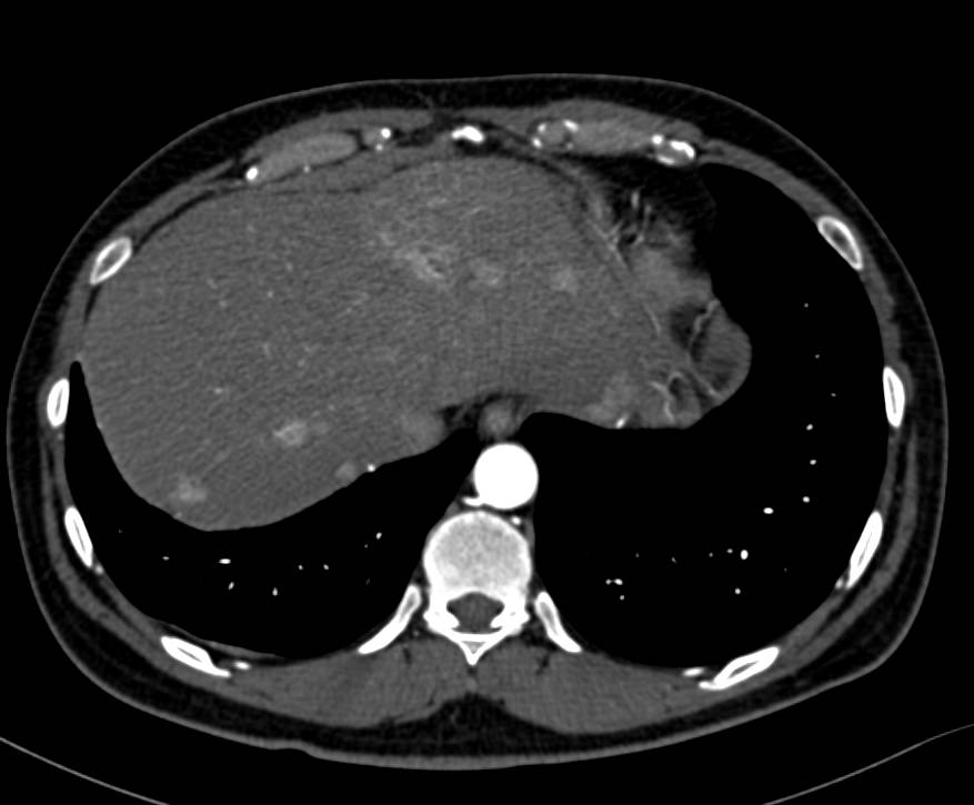 Neuroendocrine Tumor Metastatic to the Liver with Vascular Metastases - CTisus CT Scan