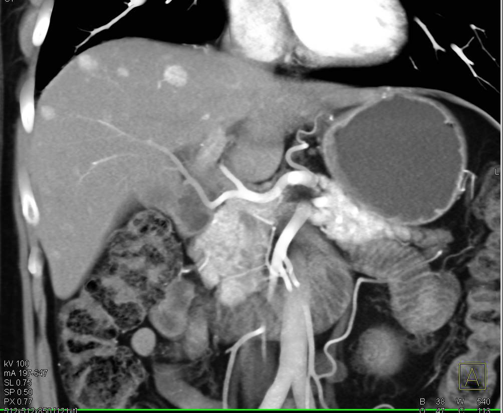 Neuroendocrine Tumor Pancreas with Liver Metastases - CTisus CT Scan