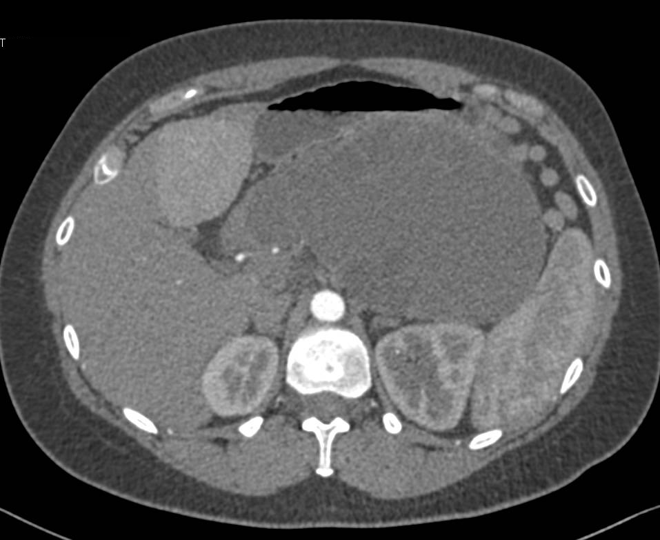 Mucinous Cystic Neoplasm (MCN) of the Pancreas with Multiple Cysts in the Large Cystic Mass - CTisus CT Scan
