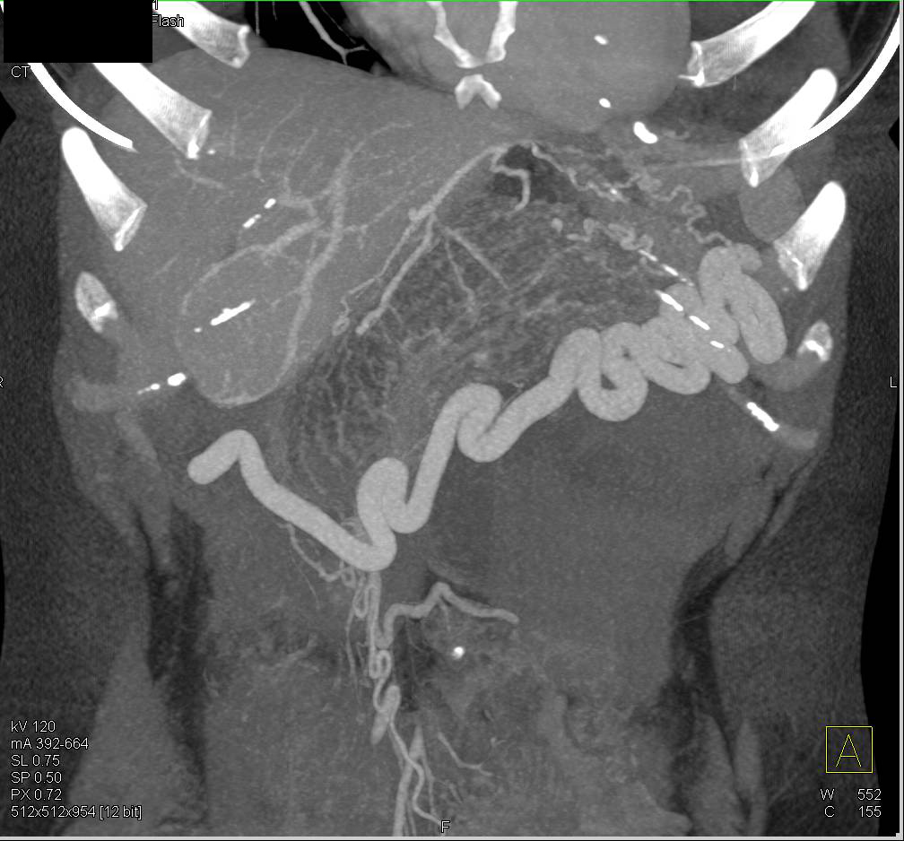 Mucinous Cystic Neoplasm (MCN) of the Pancreas - CTisus CT Scan