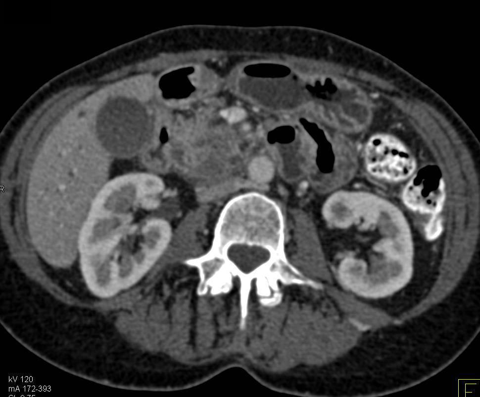 Pancreatic Adenocarcinoma with Huge Dilated Pancreatic Duct and Glandular Atrophy - CTisus CT Scan
