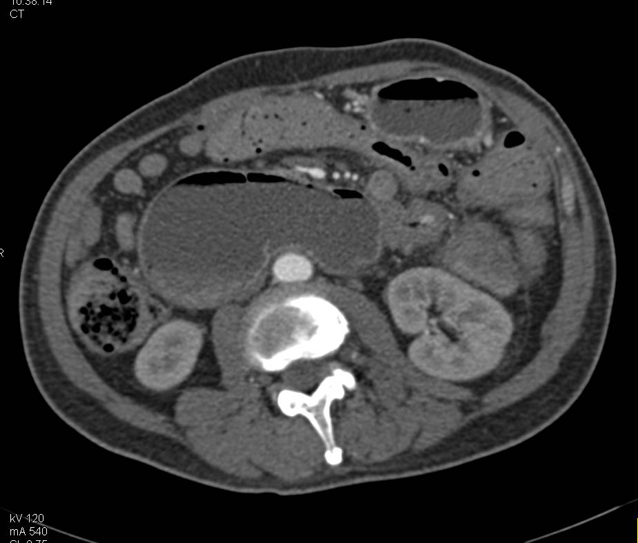 Pancreatic Cancer Obstructs the Duodenum at The Ligament of Treitz - CTisus CT Scan