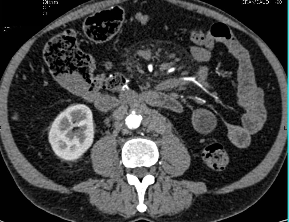 Cysts in Tail of Pancreas as well as Anenopathy in Retroperitoneum - CTisus CT Scan