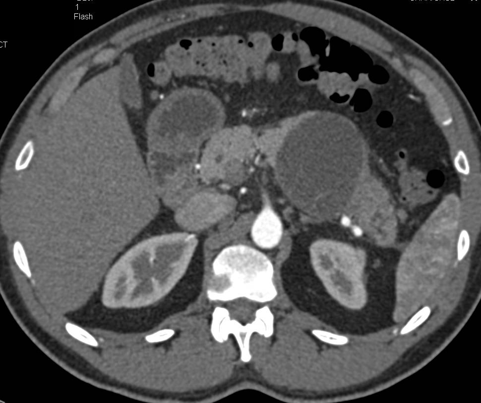 MCN (Mucinous Cystic Neoplasm) of the Pancreas - CTisus CT Scan