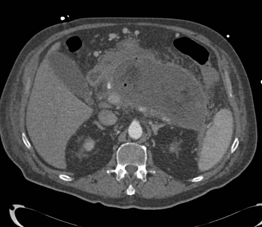 Pancreatic Necrosis with Infected Pseudocysts - CTisus CT Scan
